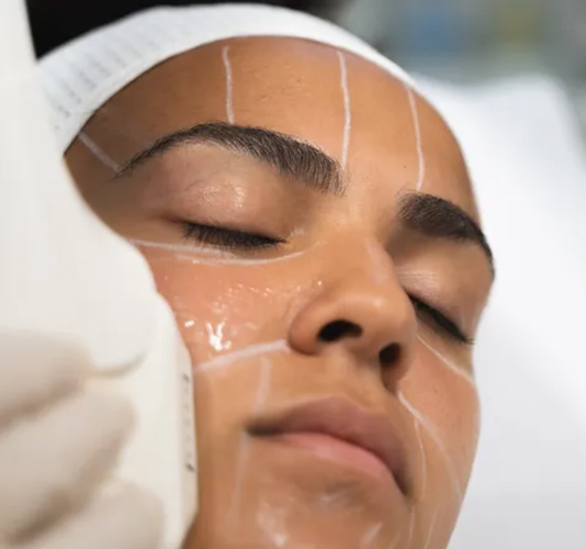 Closeup of HIFU treatment on a woman's face