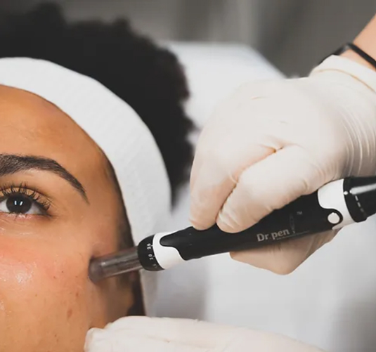 Closeup of skin needling on face