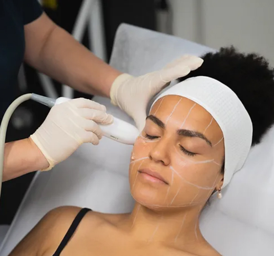 HIFU treatment on a woman's face