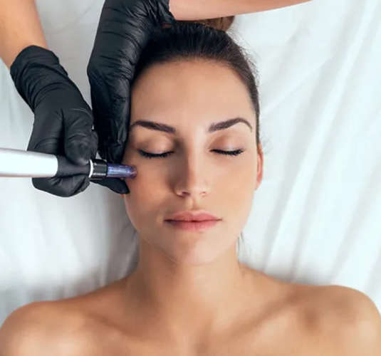 Skin needling procedure on a woman's face