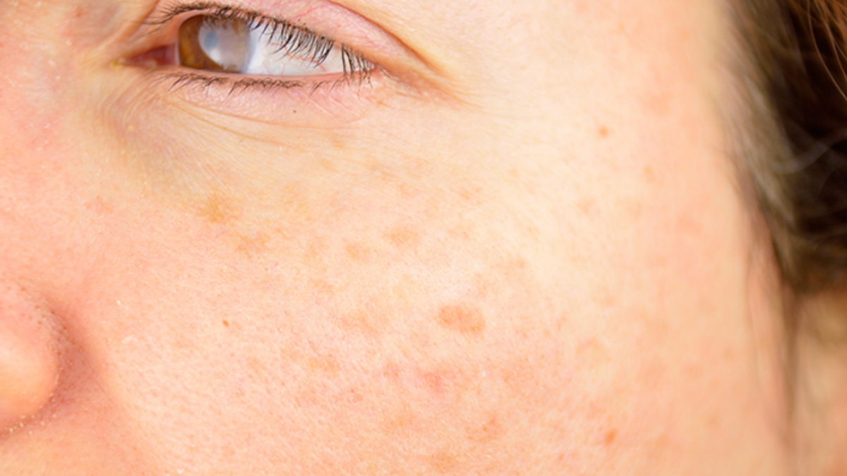 Closeup of woman's face with sun spots on her face