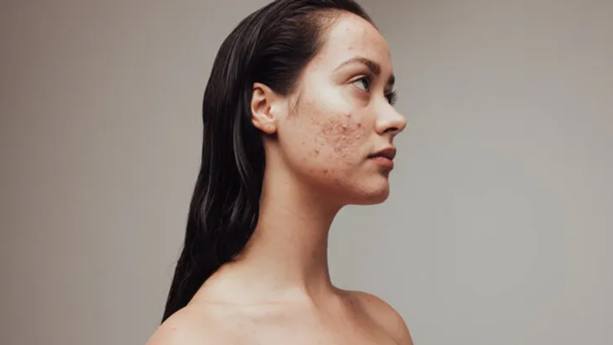 Woman with acnes on her face