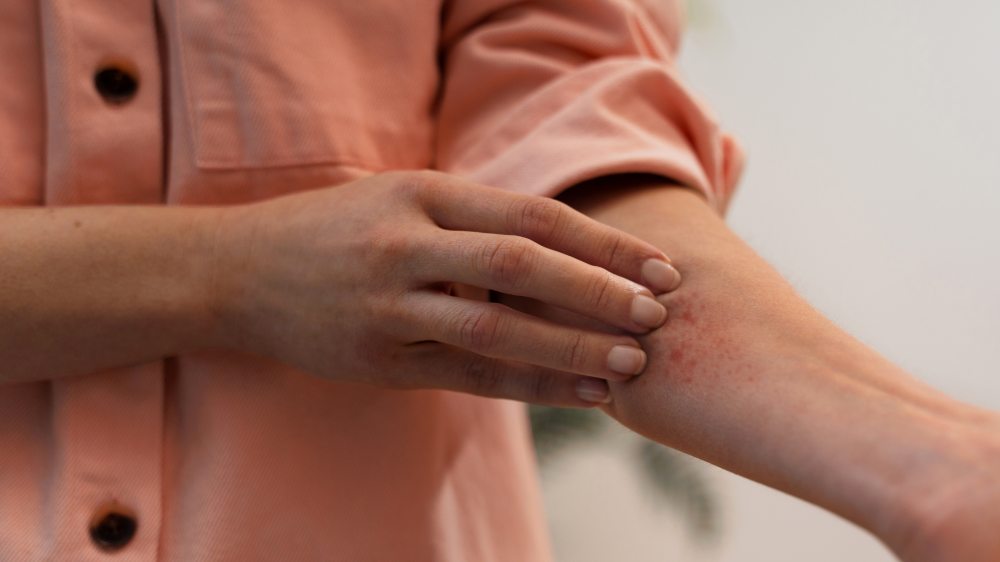 Person dealing with rosacea