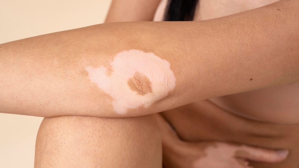 Woman showing her skin pigmentation issue